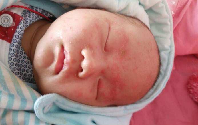 【宝宝经】湿疹是怎么引起的？宝宝为什么这么容易得湿疹？