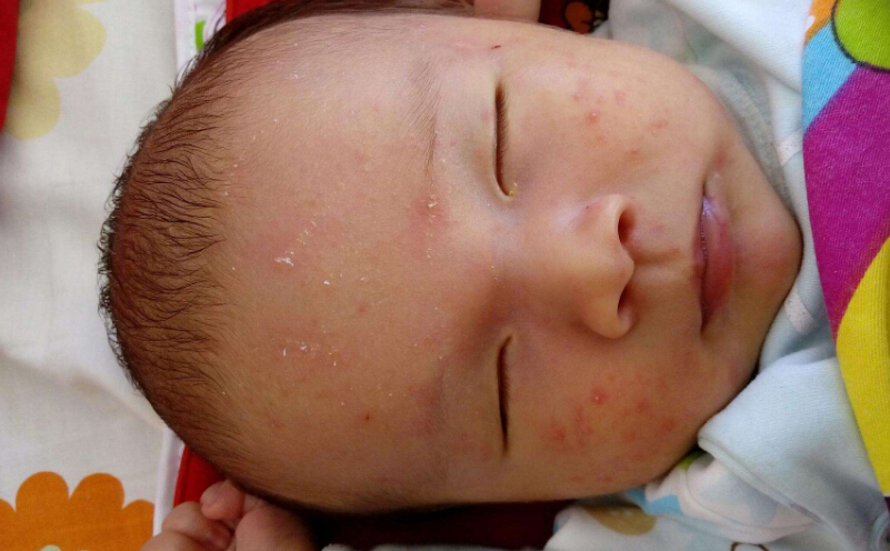 宝宝湿疹如何防范？注射疫苗会不会加重湿疹？