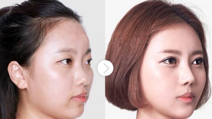 韩国koko鼻子整形外科对比图