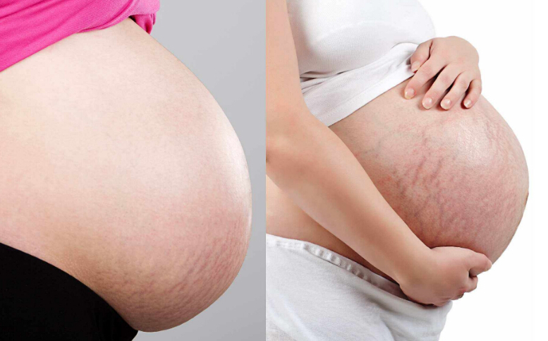 【孕百科】妊娠纹长在哪些地方？孕期妊娠纹怎么防范？
