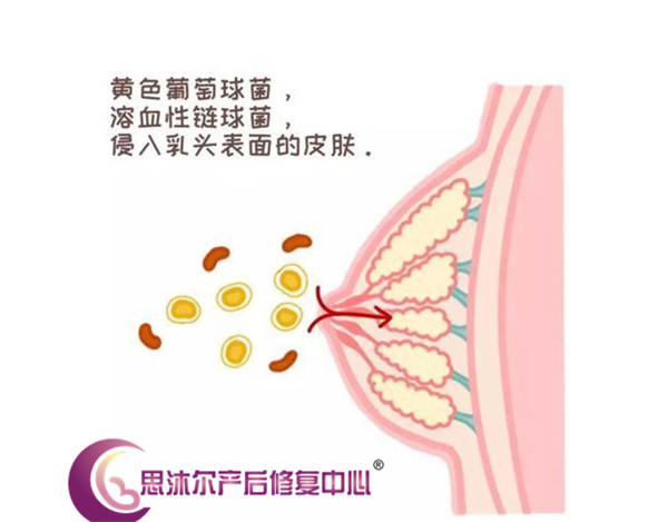 思沐尔小课堂产后乳房又硬又疼让人想断奶的乳腺炎怎么破