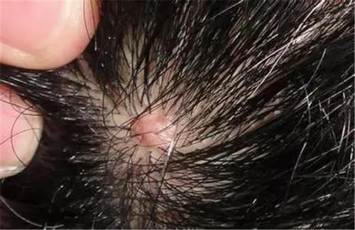 努丽雅植物养发:别在把毛囊炎当成痘痘看待了!大错特错,太可怕了!